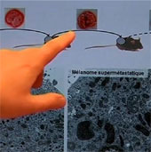 New ideas can eliminate cancer cell's metastasis