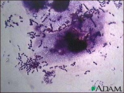 New immune disease appears
