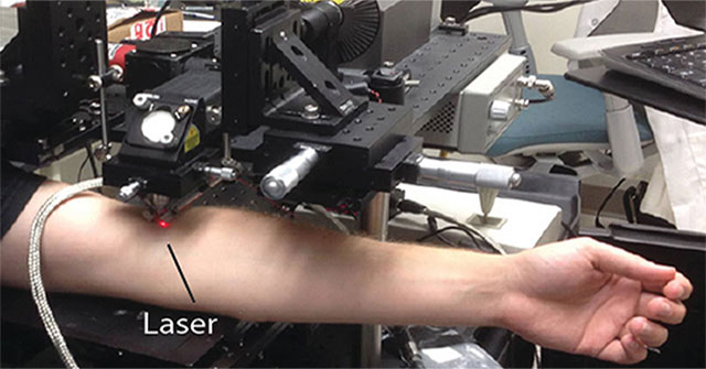 New laser technology can kill melanoma cells