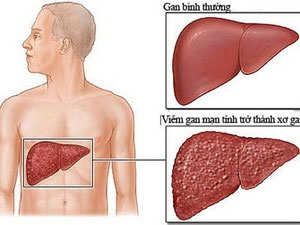 New medicine helps restore cirrhosis patients