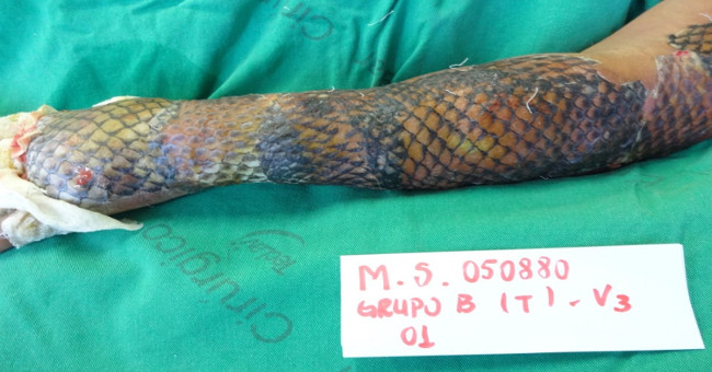 New method: Cure burns with tilapia skin