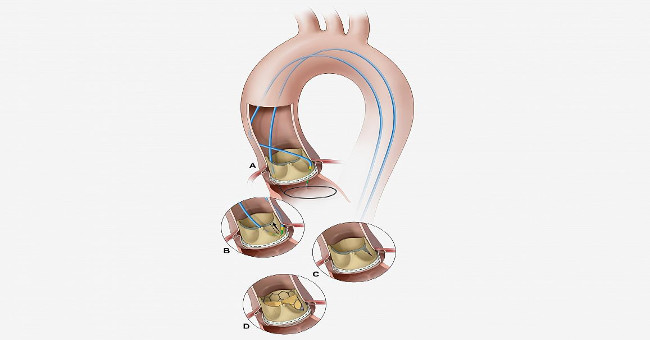 New method for safer valve replacement