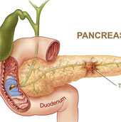 New method of early diagnosis of pancreatic cancer