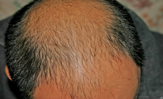 New method of treating baldness