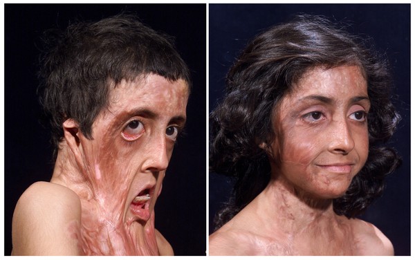 New method to treat burns without scarring