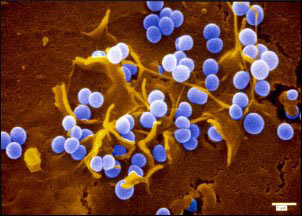 New staph can cause death in 72 hours