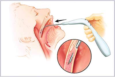 New technique to treat sleep apnea caused by snoring