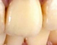 New technology helps teeth break back