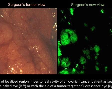 New technology in ovarian cancer surgery