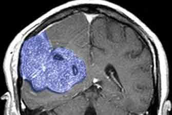 New therapy, effective in cancer treatment