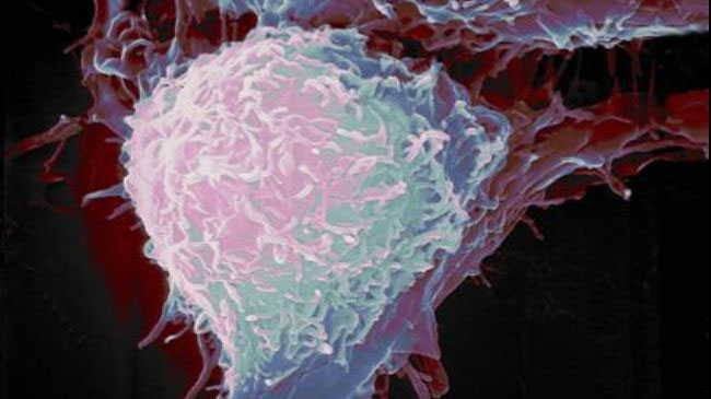 New treatment for prostate cancer
