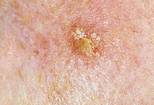 New treatment for skin cancer