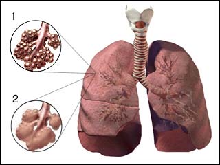 New treatments help people with emphysema
