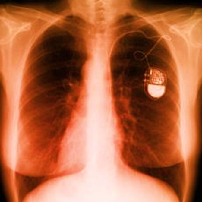 New tricks: Kill people with implantable equipment