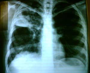 New way to diagnose and treat tuberculosis