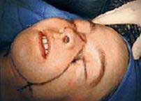 Next story about a woman with a face transplant: Amazing!