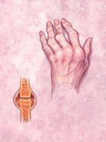Non-bacterial arthritis