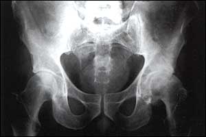 Obese men are at risk of inflammation of the hip and knee joints