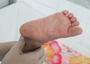 Occurrence of hand and foot disease in Hanoi