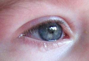 Oil in tears