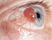 Once the eye tumor melts, the new drug combination may help