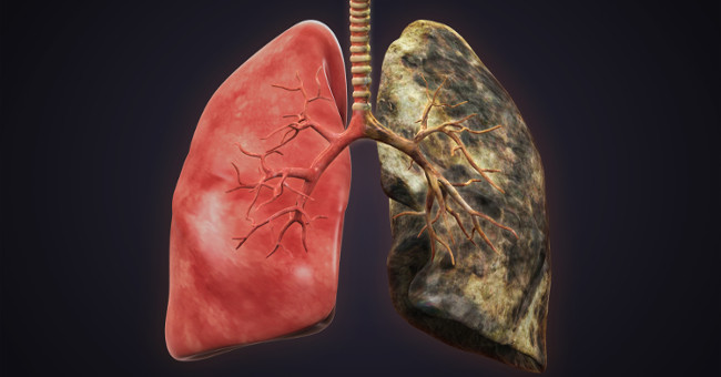 Only biomarkers help early diagnosis of lung cancer