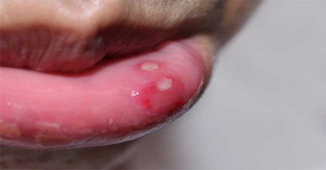 Oral heat - causes, symptoms and cures