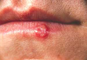 Oral tissue lesions in children