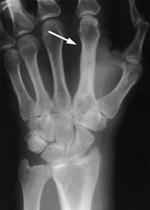 Osteomyelitis