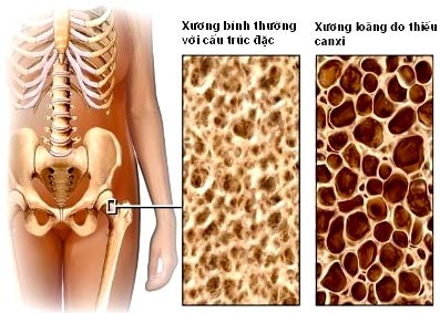 Osteoporosis: 35 years or older, be on guard