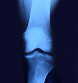 Osteoporosis and fractures