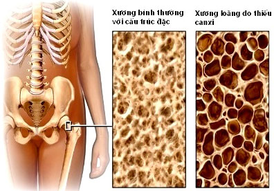 Osteoporosis - The disease is silent