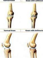 Overcoming aging of knee joints