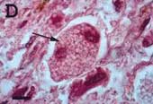 Panicillium marneffei infection: An AIDS marker