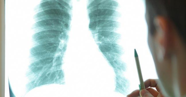 Patients with lung cancer metastasize throughout the body still cured