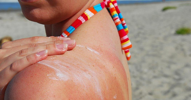 People who have to say 'no' to sunscreen