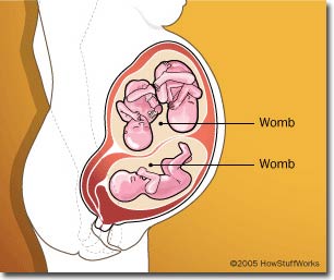 People with two uterus rarely have twins
