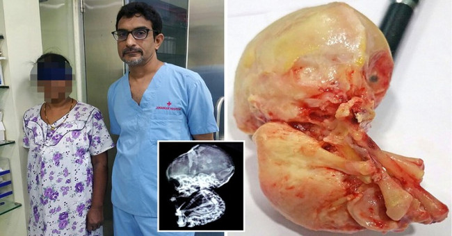 Petrified fetuses lay 15 years in the 52-year-old woman's belly