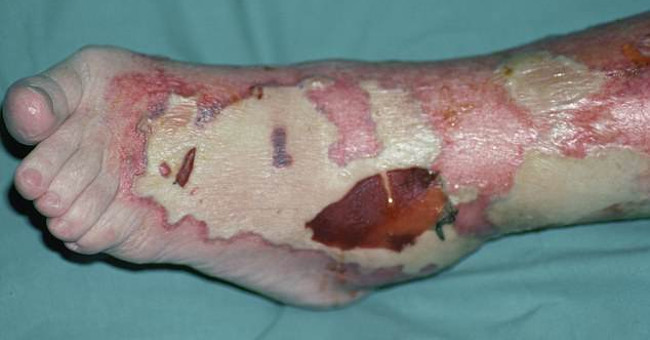Plague Buruli mysteriously spread in Australia