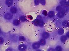 Pneumococcal pneumonia - Dangerous disease in children