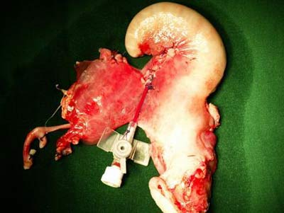 Pregnancy after uterine transplant