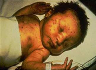 Pregnant women with Rubella infection are at risk of conception