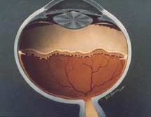 Premature infant retinopathy