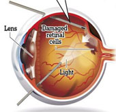 Prevent blindness by just one shot