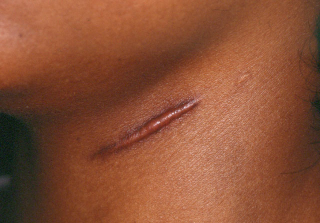 Prevent scars with ... mathematical models