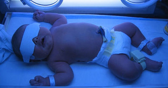 Preventing jaundice in newborns