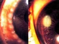 Prevention of inflammation and allergies in the eyes