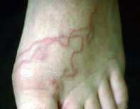 Prevention of intestinal helminthes infection