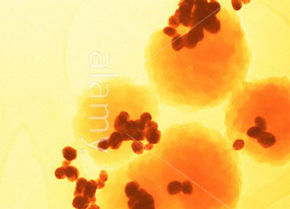 Prospects for cancer treatment by magnet
