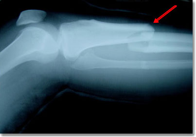 Prostate cancer increases the risk of bone fractures